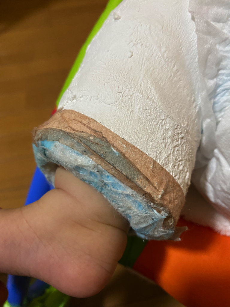 綿はマイクロポアテープで固定